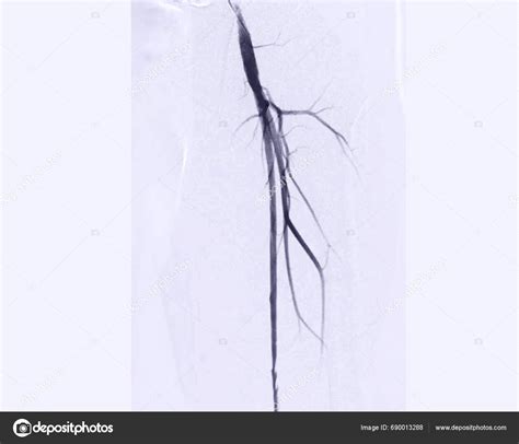 Angiogram งเป นตอนทางการแพทย ในการมองเห นหลอดเล อดในบร เวณขาหน