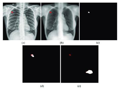 Tb Consistent Lesion Segmentation Performance Using The U Net With