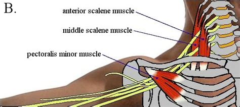 Pec Minor Tight May Pull Clavicle Compressing Brachial Plexus And Arteries Resulting In