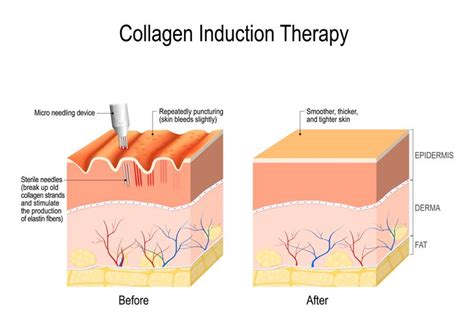 Electroporation Microneedling Medical Grade Skin Repair