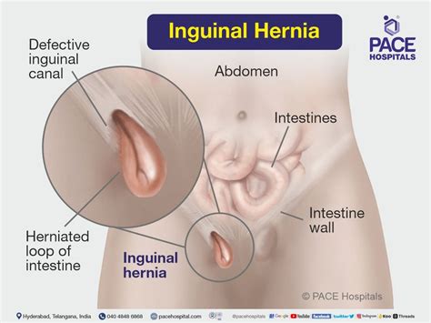 Inguinal Hernia Signs And Symptoms Types Causes Risk Factors