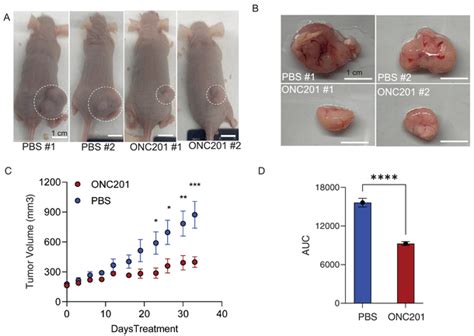 DRD2 Inhibitor ONC201 Reduces Tumor Volume In The PDXengrafted Nude