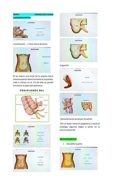 Apendicectomia Laparoscopica Anatomia Y Tecnica Quirurgica Sergio