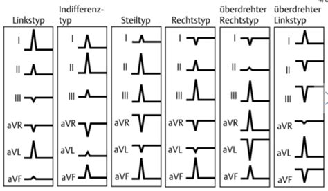 Ekg Flashcards Quizlet