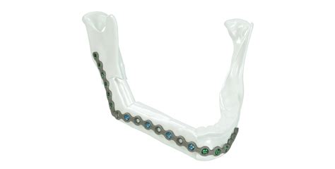 Kls Martin Ips Implants Mandible Reconstruction