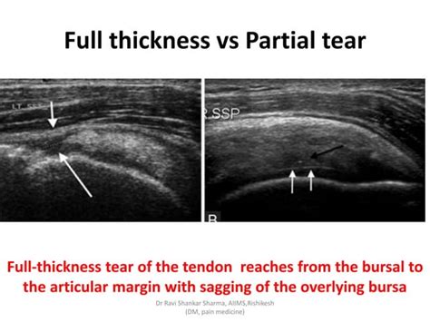 Diagnostic Ultrasound Of Shoulder Ppt