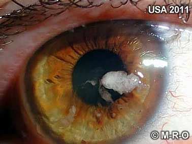 Morgellons skin lesions wounds eye infections