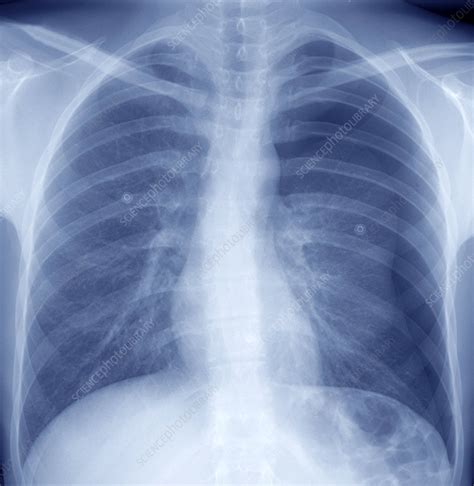 Collapsed Lung Frontal Chest X Ray Stock Image C0486102 Science