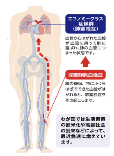 静脈血栓塞栓症とは？ 佐賀大学医学部循環器内科