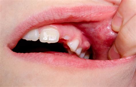 Dental Abscess Brisbane City Dentist