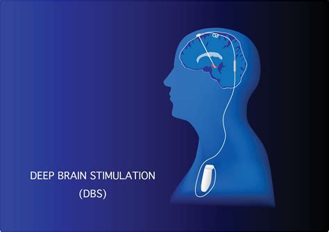 Using Deep Brain Stimulation To Treat Parkinsons Disease Visualassembler