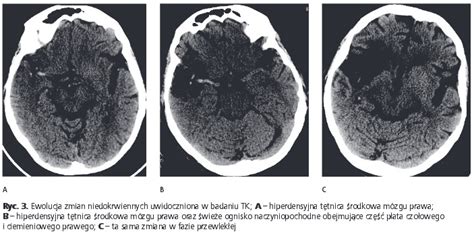 Diagnostyka obrazowa udarów niedokrwiennych strona 2 Diagnostyka