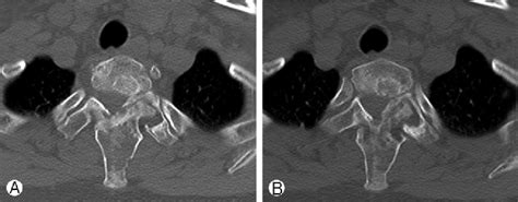 Figure 1 from Treatment of Polyostotic Fibrous Dysplasia of the ...