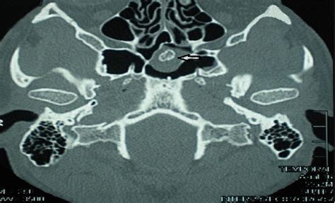 Sinolith A Rare Isolated Sphenoid Sinus Lesion Journal Of Craniofacial Surgery