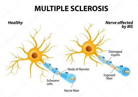 Multiple Sclerosis — Stock Vector © Edesignua 60857889