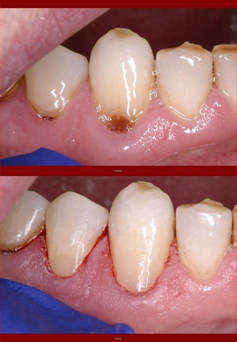 Should My Composite Restorations Last Forever Why Are They Failing At