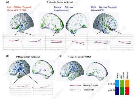 Brain Development Before And After Paediatric Bipolar Disorder Mri