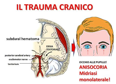 Ematoma Subdurale Che Collega Le Vene