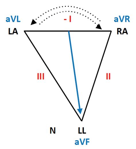 Lead reversal: Left arm/right arm • LITFL • ECG Library Diagnosis