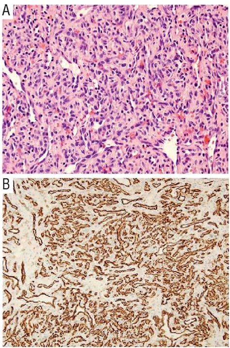 Intramedullary Capillary Hemangioma Of The Thoracic Spine Case Report