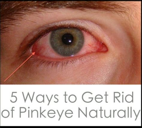 How To Tell The Difference Between Allergies And Pink Eye Artofit