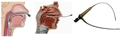 Exploring the Utility of Drug-Induced Sleep Endoscopy in the Management of Obstructive Sleep ...