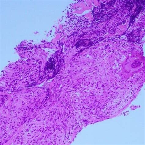 Histopathological Specimens Showing Granulomatous Inflammation With