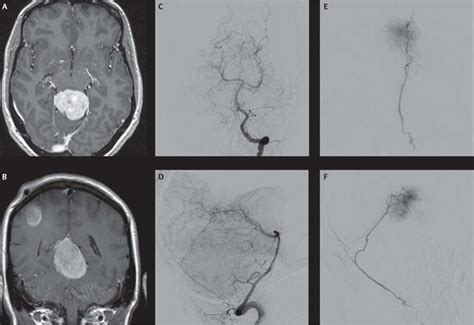 14 Diagnostic Evaluation And Embolization Of Meningiomas Neupsy Key