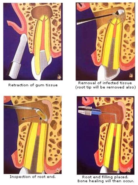 Apicectomy Explanation Exodontia