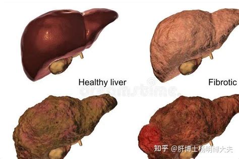 肝硬化和肝纤维化的区别 知乎