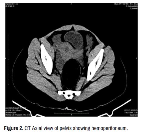 Jccr Ct