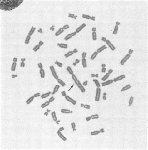 Giemsa Chromosome