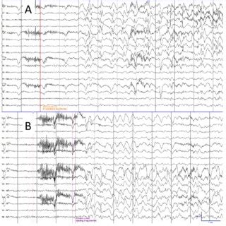 A Lateralized Periodic Discharges Lpds After Left Internal Carotid