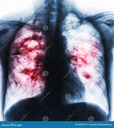 Pulmonary Tuberculosis . Film X-ray of Chest Show Cavity at Right Lung