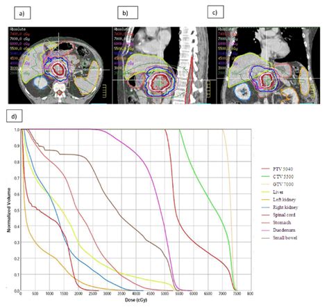 Representative Images And Treatment Plan For Dose Escalated Radiation