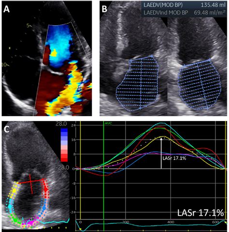 Figure 1 From Left Atrial Remodeling After Mitral Valve Repair For