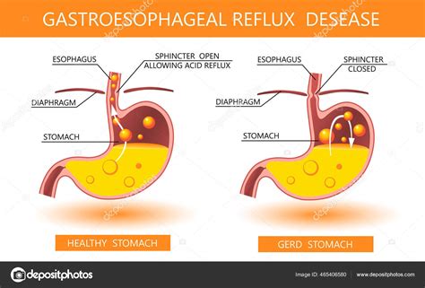 Enfermedad Por Reflujo Gastroesofágico 3d Reflujo ácido Acidez