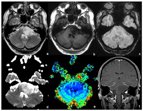 Tomography Free Full Text The Role Of Advanced Mri Sequences In The