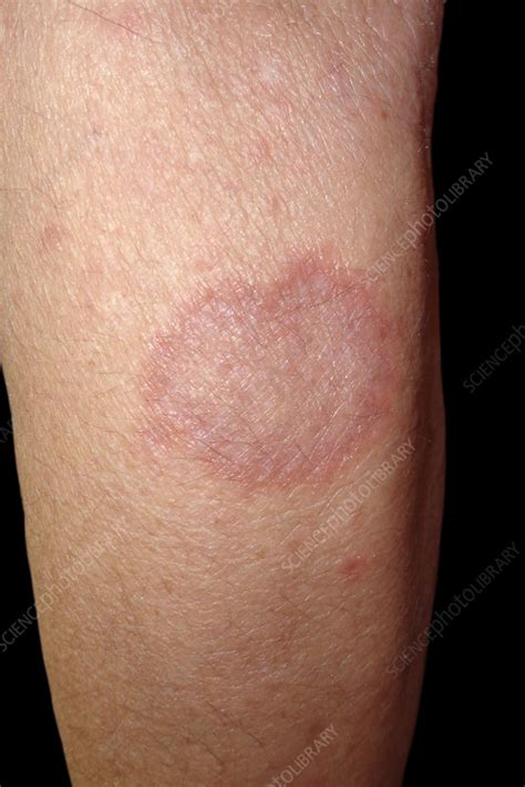 Granuloma Annulare Stock Image C040 2303 Science Photo Library