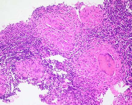 Caseous Necrosis Histology