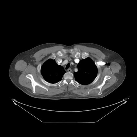 Aortic arch anomalies classifications bovine arch - wikidoc