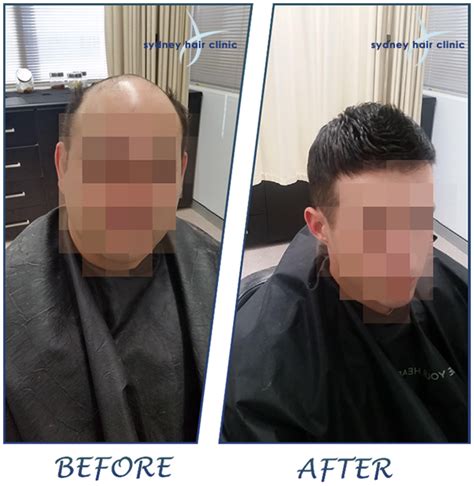 Hair Systems Sydney | #1 Non-Surgical Hair Solution