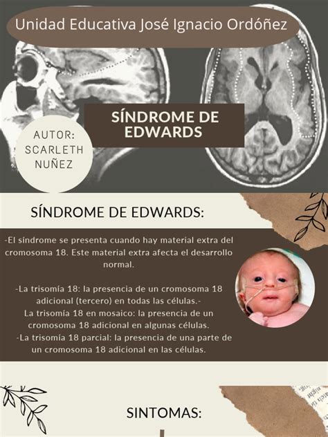 Sindrome de Edwards | PDF