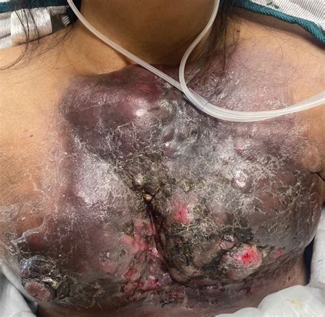 Large Indurated Plaque On The Chest With Ulceration And Necrosis Mdedge