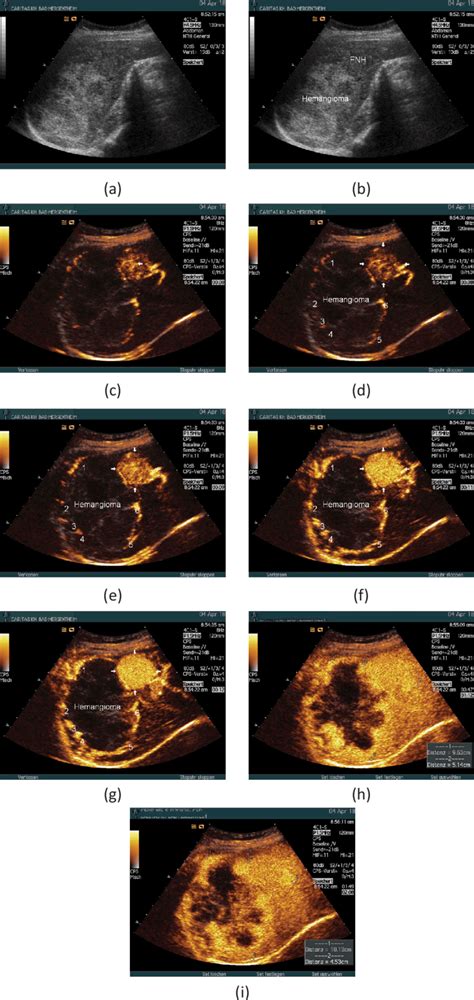 Enhancement Pattern Of A Large Focal Liver Lesion Conventional B Mode