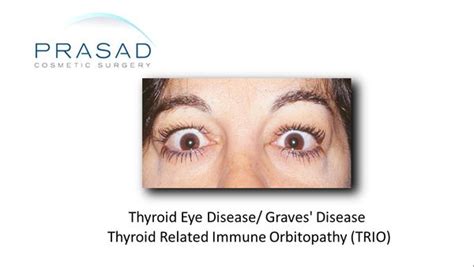 Thyroid Eye Disease Graves Disease Dr Prasad Ny