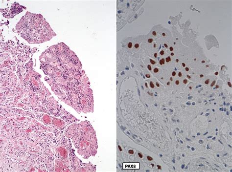 Pathology Outlines Nephrogenic Metaplasia Adenoma