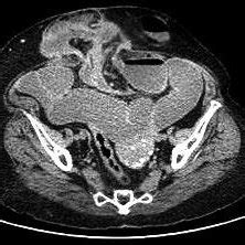 Tomografía Axial Computada de abdomen donde se observa hernia