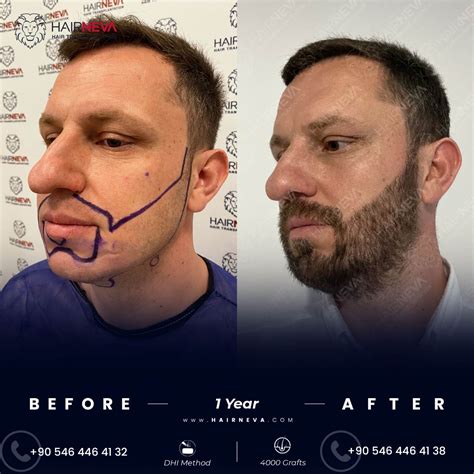 Beard Transplant Istanbul Price 2023 Updated