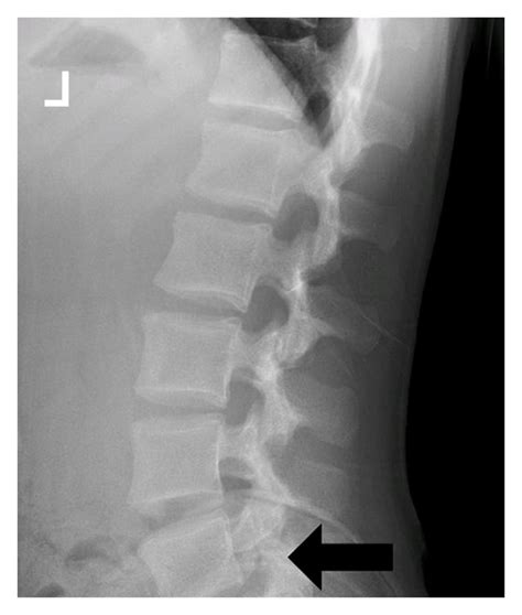 Hyperlucency seen at the L5 pars interarticularis is suggestive of ...